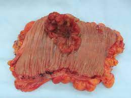 Im weiteren sinn ist ein tumor eine schwellung bzw. Neoplasm Wikipedia