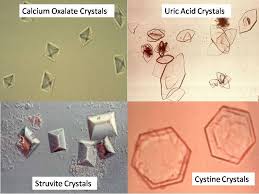 Kidney Stone Crystal Shapes Medical Laboratory Medical Laboratory Scientist Crystals