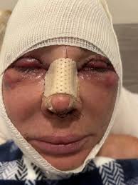 When did you start taking ozempic or saxenda after the rhino surgery?