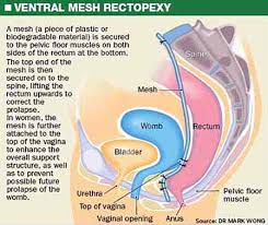 You may need a family member to. Rectal Prolapse Treatments Healthxchange