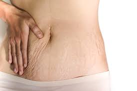 Use the product on early stretch marks. Stretch Mark Removal Treatment At Cambridge Therapeutics Cambridge Therapeutics