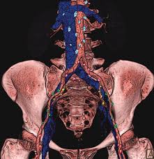 When prostate cancer spreads, cancer cells are often found in nearby lymph nodes. Pathways Of Lymphatic Spread In Male Urogenital Pelvic Malignancies Radiographics