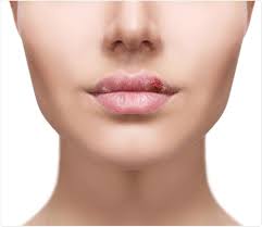 Both cause sores along with a few other symptoms. Herpes Simplex Mechanism