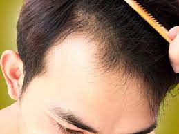 Gaya rambut botak ini bisa digunakan oleh semua bentuk wajah. 8 Model Rambut Yang Cocok Untuk Kepala Botak Depan