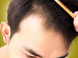 Tadi itu merupakan cara mengatasi jidat lebar dengan menambahkan poni.karena anda adalah prioritas utama yang luar biasa. 8 Model Rambut Yang Cocok Untuk Kepala Botak Depan