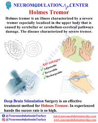 Image result for Tremor