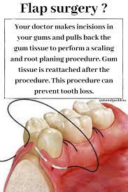 Flap Surgery Dentalhygienist Dtooth Ddentalclinic Oralhealth Dentalimplan Periodontitis Orthodontics Dental Clinic
