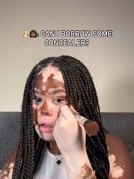 Makeup Tips for Individuals with Vitiligo