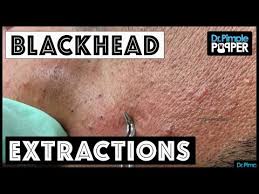 For starters, there's no blood. Most Viral Dr Pimple Popper Videos On Youtube In 2018