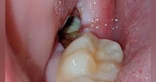 Image result for Alveolitis sicca)