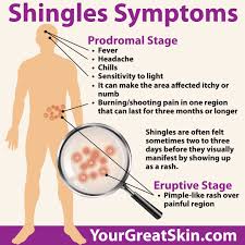 Image result for shingles
