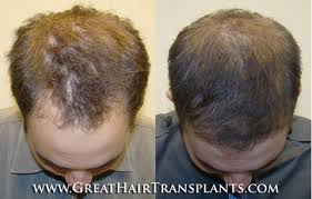 The transplanted hair from the safe donor area won't thin but the hair that is still in the thinning area will continue to miniaturize and eventually disappear. Best Rated Hair Transplant Doctor In Hawaii Kauai