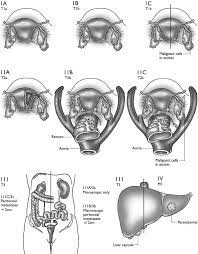 Ovarian cancer is the second most common gynecologic malignancy and is the fifth leading cause of cancer death in women. Carcinoma Of The Ovary Staging Ovarian Cancer Primary Tumor And Download Scientific Diagram