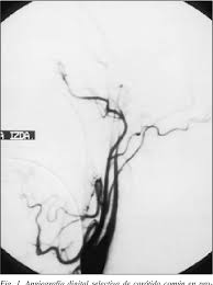De igual modo, se distinguen los componentes de cada postura, que incluyen conceptos o definiciones filosóficas, criterios médicos y pruebas. Valor Diagnostico De La Angiografia Cerebral En La Confirmacion De La Muerte Encefalica Ventajas E Inconvenientes Semantic Scholar