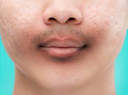 Remes for black spots of lips how to reduce spot from 10 best home remes to cure black spots on the lips 3 ways to get rid of the dark area around mouth wikihow black spots on the lips 13 causes 10 best home remes to cure black spots on the lips discolored lips what it means and how to treat them black spots on lips 11 causes how to get pink. How To Get Rid Of The Dark Skin Around Lip And Chin Lifealth