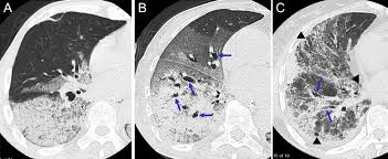 The main complication in ards is that fluid leaks into the lungs making breathing difficult or. Fibroproliferative Changes On High Resolution Ct In The Acute Respiratory Distress Syndrome Predict Mortality And Ventilator Dependency A Prospective Observational Cohort Study Bmj Open