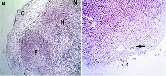 While the loss of vision is often associated with getting older, according to the national eye institute, approximately 11 million americans age 12 or older could impr. A Cam Invasion To The Ovarian Grafted Tissue Cam Invasion C Download Scientific Diagram