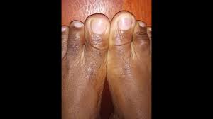 Maybe you would like to learn more about one of these? How To Get Rid Of Toenail Fungus Cupidandi Com