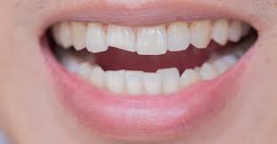 Think of it like removing a fence post or tree stump out the con is the tooth possibly could break off, you might not be addressing potential infection and/or abscess. What Happens If I Leave A Cracked Or Broken Tooth Untreated