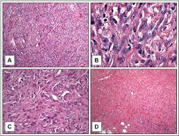 This cell type is the least common and most aggressive mesothelioma cell type, leading to the poorest. Histopathology Of Sarcomatoid Dmm Panels A And B One Of The More Download Scientific Diagram