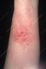Image result for Rhus Dermatitis
