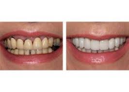 The experts at webmd offer tips for finding the right dentist for you and your family. Leading Cosmetic Dentists Gaps Crooked Discoloured Teeth Tps