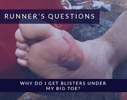 Unlike friction blisters that contain a clear liquid, blood blisters contain a red fluid. Why Do I Get Blisters Under My Big Toe Alexandra Sports