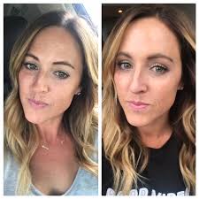 IPL Photofacial Results with Juvly Aesthetics