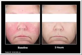 Here the trialist is a the `baseline' before starting treatment. Mirvaso Before And After Pictures Rosacea Support Group