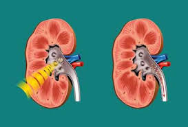 Kidney Stones Faq Urology Conditions London Urology