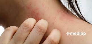 Image result for dermatitis contacta allergica