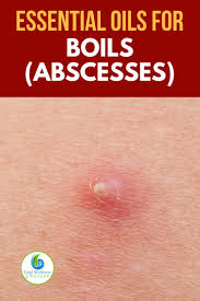 5 Best Essential Oils For Boils Abscesses That Really Work 5 best essential oils for boils