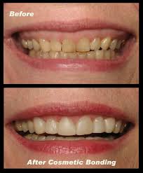 Make an appointment with your dentist to find out if dental veneers are the right solution for improving confidence in your smile. Fiddlehead Dental Fiddlehead Dental