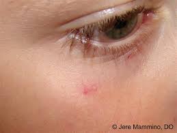 Cherry angiomas are small benign blood tumours which occur when capillaries overgrow.they are usually red or purple/bluein colour and most commonly found on the. Angiomas American Osteopathic College Of Dermatology Aocd
