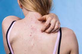 Back Acne: 9 Tips To Get Clearer Skin