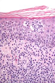 There is a much greater predilection to disseminate to extranodal sites than in hodgkin's lymphoma. Cutaneous T Cell Lymphoma Wikipedia