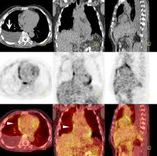 • mesothelioma may be confused with metastatic adenocarcinoma, other mets to pleura, such as thymoma metastatic to pleura • mesothelioma: Pleural And Peritoneal Mesothelioma Imaging Findings On Ct And Fdg Pet Ct Sciencedirect
