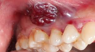 Small chips, a bump on the roof of your mouth, or even a tiny ulcer under your tongue are easy to pick out from the healthy or normal oral tissues around them. Hard Bump On Roof Of Mouth Possible Causes Medical Suggestions