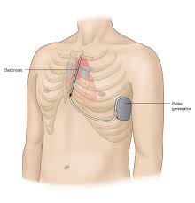 Image result for Internal Cardiac Defibrillator
