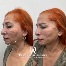 Neck Lift & Décolleté