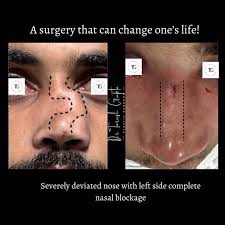One of the Most Challenging Rhinoplasty: This young man had severe trauma  to the face. His nose, as seen, was completely shattered and deviated so  much that it doesn’t fit into any classification. His ...