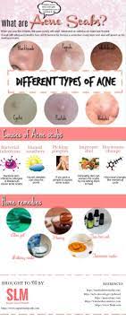 Sie suchen den besten sale? 40 Best Ways To Get Rid Of Acne Scabs Overnight Diy Home Remedies