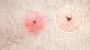 Image result for mite bites on humans