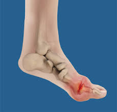 Image result for gout symptoms toe