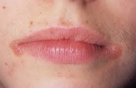 Maybe you would like to learn more about one of these? Sakit Bibir Atau Di Sudut Mulut Punca Utama Dan Cadangan Rawatan