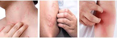 Teruk gila lepastu busuk tak. Eczema Causes Symptoms Treatments Premier Clinic