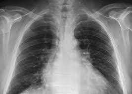 We did not find results for: Mimic Chest X Ray Database To Provide Researchers Access To Over 350 000 Patient Radiographs Mit News Massachusetts Institute Of Technology