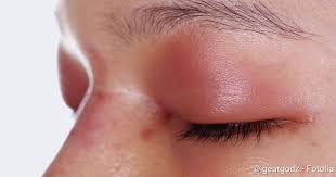 Phlegmone Ursachen Symptome Therapie Netdoktor