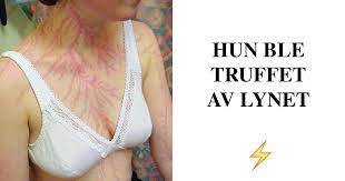 Check spelling or type a new query. 15 Personer Som Overlevde Lynnedslag Og Hva Det Gjor Med Huden Din