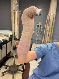 Image result for Ulnar Gutter Cast